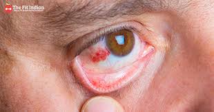 A red eye can be caused by many things, and often produces irritating symptoms. 10 Natural Home Remedies To Soothe Your Bloodshot Eyes