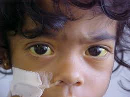 Colestase neonatal: Principais causas & abordagem diagnóstica