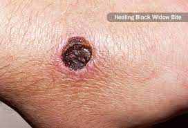 In most cases, a spider bite can look like a dartboard. Spider Bites Pictures To Identify Spiders And Their Bites