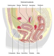 Gebärmutterschleimhautartiges gewebe siedelt sich dabei an stellen im unterleib an, wo es eigentlich gar nicht hingehört. Allgemeine Gynakologie Leistungsspektrum