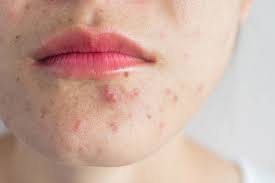 Acne Banco De Imagens E Fotos De Stock Istock