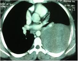 Ribs is an ethereal lament about adolescence, and the bittersweet experience of growing up. Is Your Heart Under Your Third Rib Heart Gross Anatomy Each Of The Chambers Has Two Connected Parts Praste Waee