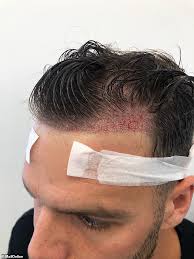 Ağrısız ve iğnesiz saç ekimi fiyatları için hemen bilgi alın. Love Island S Dom Lever Reveals He S Had A Hair Transplant Daily Mail Online