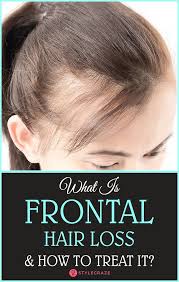 What Is Frontal Hair Loss And How To Treat It Frontal Hair Loss Hair Loss Treat Hair Loss