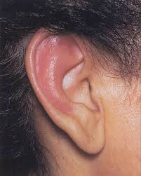 Image result for Relapsing Polychondritis