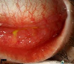 Image result for Chlamydia Trachomatis