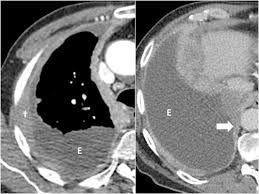 A computed tomography scan is very helpful if the lungs themselves are diseased. State Of The Art Radiological Investigation Of Pleural Disease Sciencedirect