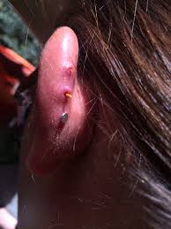 Maybe you would like to learn more about one of these? Home Remedies For Ear Piercing Infections The Tipsy Gypsies