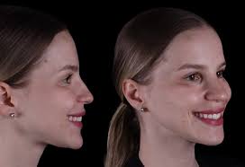 Este caso mostra como a cirurgia ortognática pode promover mudanças  funcionais e estéticas relevantes. Houve melhora importante no contorno  facial, na projeção do mento e na harmonia do nariz, com redução do