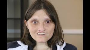 Duplications of chromosome 8p lead to rare genetic conditions characterized by variable phenotypes. Liz S Humanity Chromosome 18 Deletion Youtube