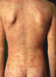 Characterized by scaly, pink, inflamed skin, the condition can last from 1 to 3 months and usually leaves no lasting marks. Pityriasis Rosea Like Eruption Revealing Covid 19 Veraldi 2021 Australasian Journal Of Dermatology Wiley Online Library