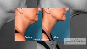 Everyone here is willing to help. Get Rid Of Your Double Chin Without Losing Weight James Christian Cosmetics Ny