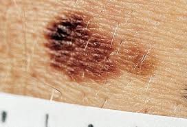 Here, a dermatologist shares more common signs of skin cancer to the swatch may be itchy and peel, and so it could seem an awful lot like dry skin. Skin Cancer Symptoms Types Images