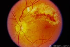 Image result for HIV Retinitis