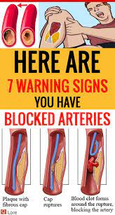 Maybe you would like to learn more about one of these? Here Are 7 Warning Signs You Have Blocked Arteries Arteries Warning Signs Signs