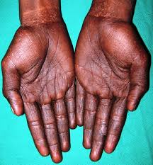 Treatment for naegeli syndrome is based on an individual's symptoms. Dyschromatosis Universalis Hereditaria A Case Report