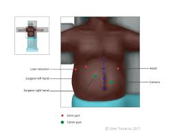 The incisions are made in the neck, chest and abdomen (belly) to remove the esophagus and rebuild the gastrointestinal tract. Minimally Invasive Esophagectomy Tips And Pitfalls Ctsnet
