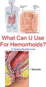How long do external hemorrhoids last. 8 Amazing And Unique Tips Can Change Your Life How To Have A Bowel Movement With Hemorrhoids A Bleeding Hemorrhoids Hemorrhoids Treatment Cure For Hemorrhoids