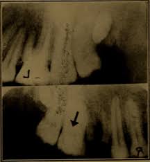 It is a dental abscess that can occur immediately following root canal treatment. Pulp Stone Wikipedia