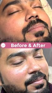 ✨ Transform your skin with BioRePeel! ✨, Say goodbye to dullness and hello  to a radiant, rejuvenated glow 🌟. Watch these incredible before & after  results and see how BioRePeel works its magic by ...