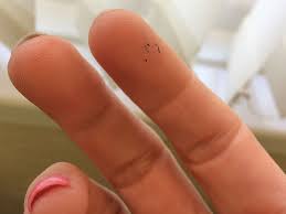 If you prefer not to have any hair, feel free to shave as often as you need, but wait about 10 days after your treatment. Facial Laser Hair Removal Session 1 My Diary Entry 37