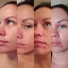 20 Things That Really And Truly Work On Cystic Acne In 2020 Best Acne Spot Treatment Cystic Acne Acne Spots
