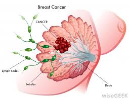 Sentinel lymph node mapping helps to identify the lymph nodes that are at highest risk for containing cancer. What Are The Concerns About Breast Cancer In The Lymph Nodes