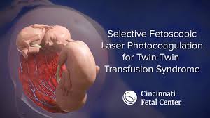 Genetically, the two babies are identical. Twin Twin Transfusion Medical Animation Cincinnati Fetal Center Youtube