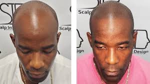 Before and After Photos of Scalp Micropigmentation (SMP)