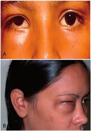 Uncommon clinical presentations: (A) Eightyear-old child presenting...