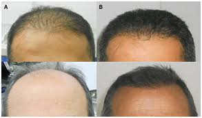 Stay tuned and watch ryan's hair grow and learn about the stages of hair growth. Evolution Of Hair Transplantation