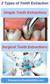 Surgical extraction is typically reserved for teeth that are below the surface, impacted, or your dental health questions may seem daunting, but i'm guessing we've seen whatever problem you're facing. Emergency Tooth Extraction Near Me 24 7 No Insurance Ok