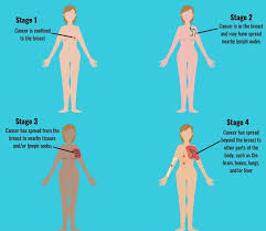 We lost count at 9 but after the initial biopsy, the first of many, and a lumpectomy. Breast Cancer Awareness Month How Early Detection Can Save Lives Greek Herald
