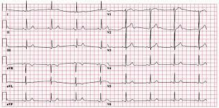 Maybe you would like to learn more about one of these? Ecg Ekg Examples And Quiz Oxford Medical Education