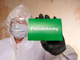 Image result for Pallidotomy