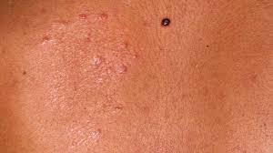 Leprosy Symptoms Pictures Types And Treatment