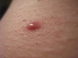 Ingrown hair vs genital herpes; Pimple Or Ingrown Hair A Photo On Flickriver