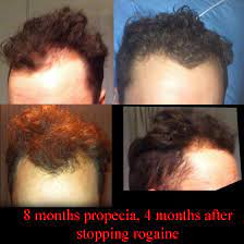 Hair loss after temporarily stopping rogaine (minoxidil): Regarding Minoxidil Stoppage Baldtruthtalk Com