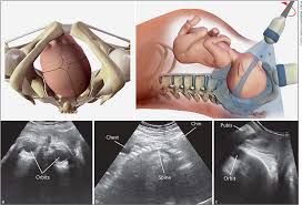 Image result for Brow Presentation