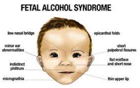 Fetal Alcohol Syndrome And Pregnancy Inspire Malibu