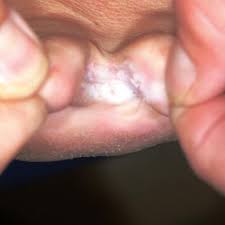 Athlete S Foot That Won T Go Away Clinician Reviews