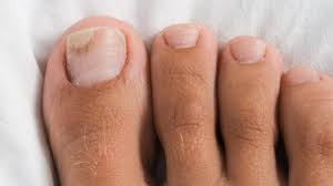 Image result for Onycholysis feet