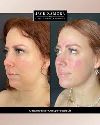 Lower face goals, 𝘢𝘤𝘩𝘪𝘦𝘷𝘦𝘥 ✨ This beautiful result comes from a  combination approach: ATTIVA iRF for the lower face, chin lipo, and a  suture lift. Together, they help refine contours and enhance