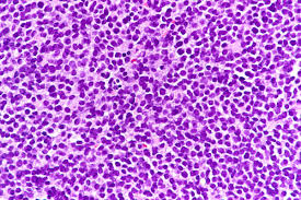 St Jude Research On Twitter Ewing Sarcoma Is A Cancerous Tumor That Grows In The Bones Or Tissue Around Bones Often Legs Pelvis Ribs Arms Or Spine Although It S Rare Ewing Sarcoma Is