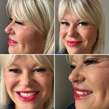 Love working with Heal MedSpa to keep a fuller yet natural look for my 👄  All the providers are absolutely wonderful and will help you reach your  aesthetic goals🙌🏼 Call Slightly North