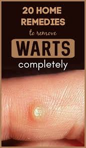 How To Get Rid Of Warts Home Remedies More With Images Home Remedies For Warts Warts Remedy Get Rid Of Warts