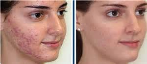 Ainsi, à raison d'une fois par semaine, chouchoutez votre peau avec le masque. Peeling Anti Acne Images Avant Apres Institut Akhena