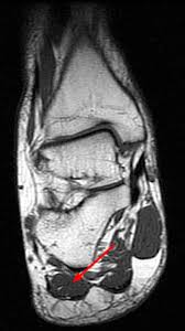 This is a 30 year old with swelling on the lateral aspect of foot with evidence of soft tissue lesion in relation to the lateral aspect of the talus which appears isointense to the muscles on t1 and t2. Baxter S Nerve First Branch Of The Lateral Plantar Nerve Impingement Radsource