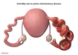 Image result for Acute Cervicitis