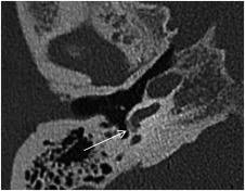 Image result for Myringosclerosis